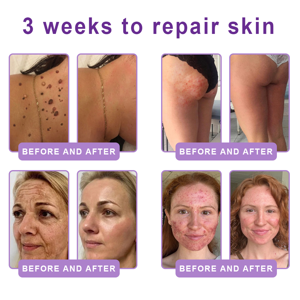 𝐇𝐈𝐒𝐊𝐈𝐍® 𝐏𝐃𝐑𝐍 𝐌𝐮𝐥𝐭𝐢-𝐏𝐞𝐩𝐭𝐢𝐝𝐞 𝐌𝐚𝐬𝐬𝐚𝐠𝐢𝐧𝐠 𝐁𝐨𝐝𝐲 𝐑𝐨𝐥𝐥𝐞𝐫 𝐂𝐫𝐞𝐚𝐦- 𝐀𝐧𝐭𝐢-𝐚𝐠𝐢𝐧𝐠, 𝐇𝐲𝐝𝐫𝐚𝐭𝐢𝐧𝐠, 𝐒𝐤𝐢𝐧 𝐅𝐢𝐫𝐦𝐢𝐧𝐠 & 𝐋𝐢𝐟𝐭𝐢𝐧𝐠, 𝐒𝐤𝐢𝐧 𝐑𝐞𝐩𝐚𝐢𝐫, 𝐄𝐯𝐞𝐧 𝐓𝐨𝐧𝐞, 𝐀𝐜𝐧𝐞 𝐚𝐧𝐝 𝐃𝐚𝐫𝐤 𝐒𝐩𝐨𝐭 𝐓𝐫𝐞𝐚𝐭𝐦𝐞𝐧𝐭, 𝐖𝐚𝐫𝐭 𝐚𝐧𝐝 𝐌𝐨𝐥𝐞 𝐑𝐞𝐦𝐨𝐯𝐚𝐥, 𝐚𝐧𝐝 𝐏𝐬𝐨𝐫𝐢𝐚𝐬𝐢𝐬 𝐑𝐞𝐥𝐢𝐞𝐟.