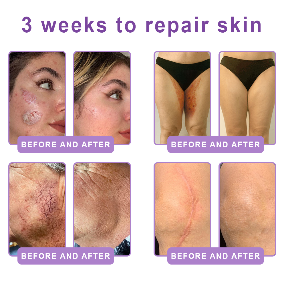 𝐇𝐈𝐒𝐊𝐈𝐍® Only 10 Boxes!!! Get an exclusive 80% OFF now. ✨ See visible firming in just 7 days! ✔️ Backed by our 180-day money-back guarantee.