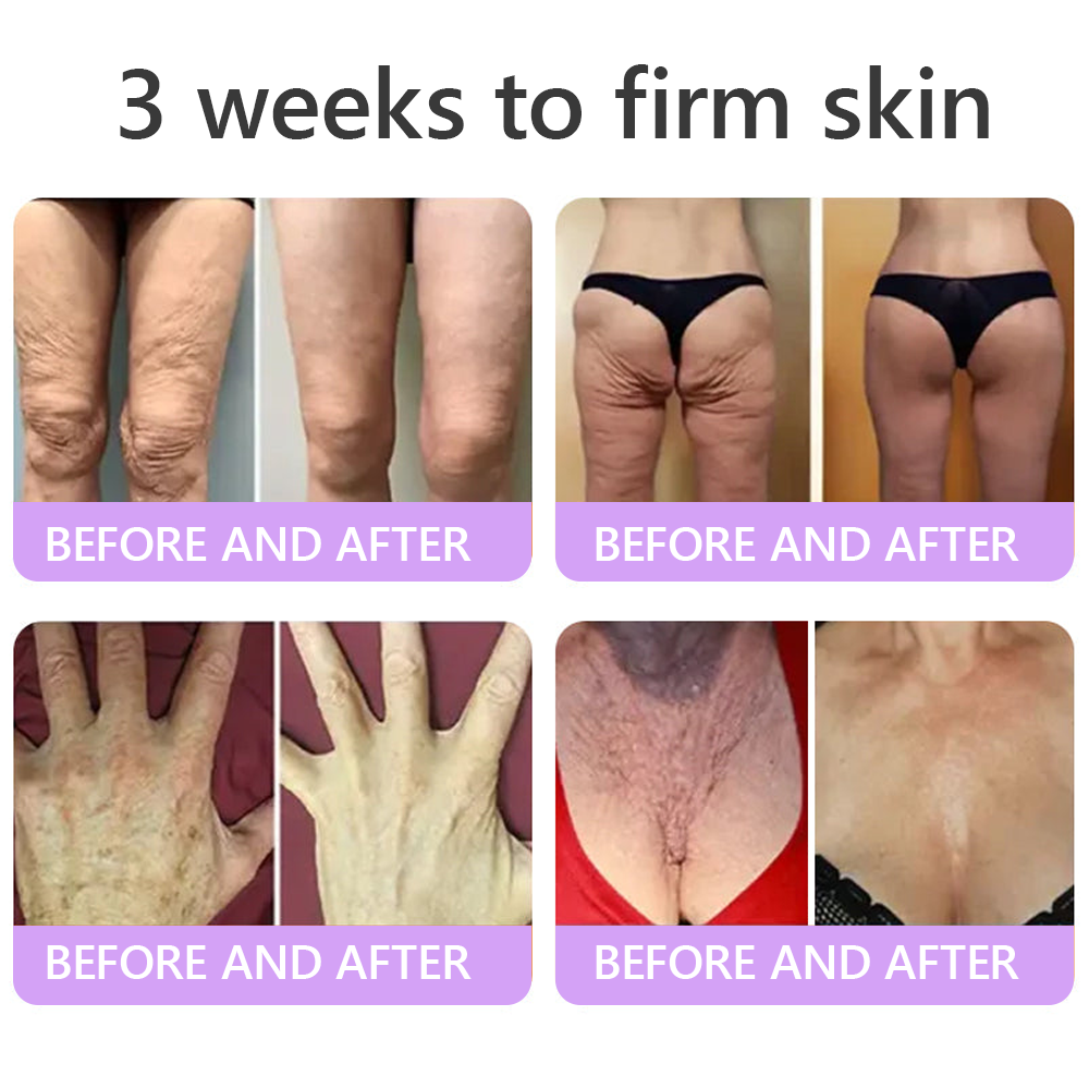 𝐇𝐈𝐒𝐊𝐈𝐍® 𝐏𝐃𝐑𝐍 𝐌𝐮𝐥𝐭𝐢-𝐏𝐞𝐩𝐭𝐢𝐝𝐞 𝐌𝐚𝐬𝐬𝐚𝐠𝐢𝐧𝐠 𝐁𝐨𝐝𝐲 𝐑𝐨𝐥𝐥𝐞𝐫 𝐂𝐫𝐞𝐚𝐦- 𝐀𝐧𝐭𝐢-𝐚𝐠𝐢𝐧𝐠, 𝐇𝐲𝐝𝐫𝐚𝐭𝐢𝐧𝐠, 𝐒𝐤𝐢𝐧 𝐅𝐢𝐫𝐦𝐢𝐧𝐠 & 𝐋𝐢𝐟𝐭𝐢𝐧𝐠, 𝐒𝐤𝐢𝐧 𝐑𝐞𝐩𝐚𝐢𝐫, 𝐄𝐯𝐞𝐧 𝐓𝐨𝐧𝐞, 𝐀𝐜𝐧𝐞 𝐚𝐧𝐝 𝐃𝐚𝐫𝐤 𝐒𝐩𝐨𝐭 𝐓𝐫𝐞𝐚𝐭𝐦𝐞𝐧𝐭, 𝐖𝐚𝐫𝐭 𝐚𝐧𝐝 𝐌𝐨𝐥𝐞 𝐑𝐞𝐦𝐨𝐯𝐚𝐥, 𝐚𝐧𝐝 𝐏𝐬𝐨𝐫𝐢𝐚𝐬𝐢𝐬 𝐑𝐞𝐥𝐢𝐞𝐟.